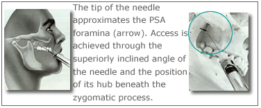 PSA nerve block